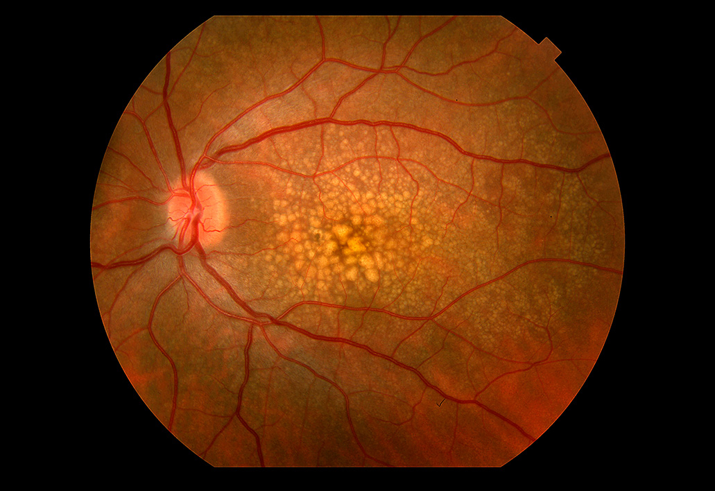 Yellow Spot Disease (Macular Degeneration) - Özel Karşıyaka Göz Hastanesi